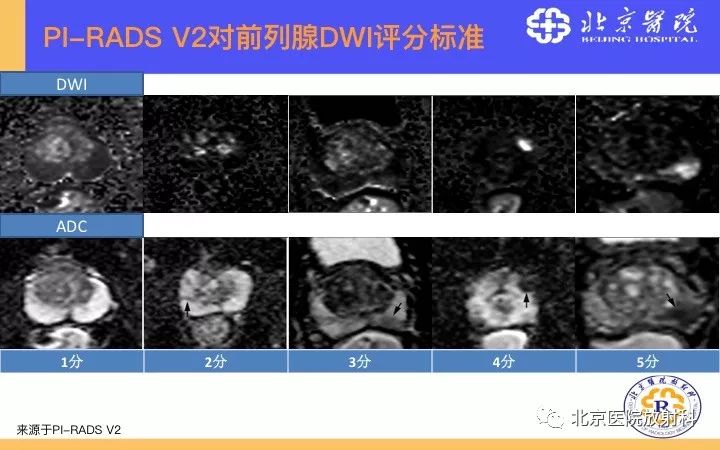 【PPT】男性盆腔常见疾病MR诊断