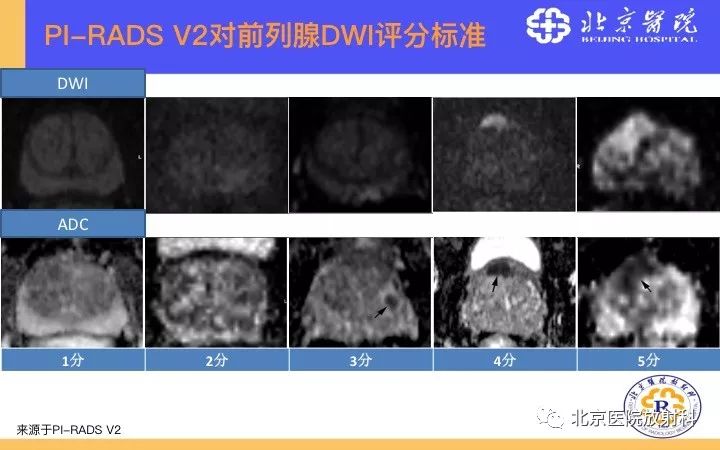【PPT】男性盆腔常见疾病MR诊断