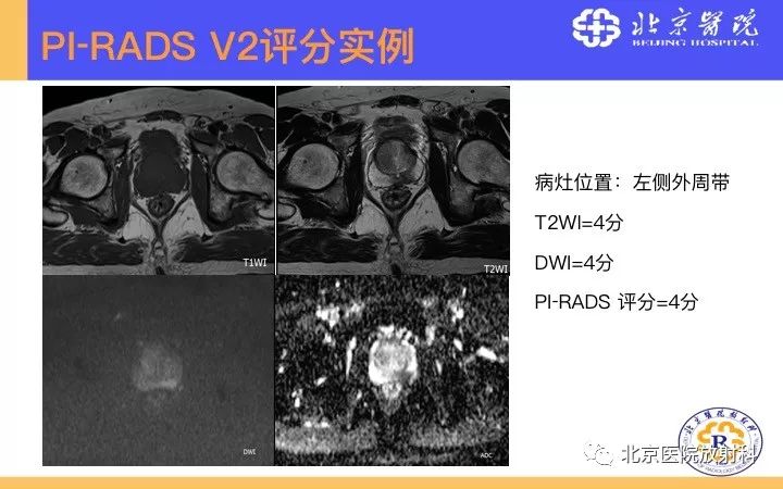 【PPT】男性盆腔常见疾病MR诊断