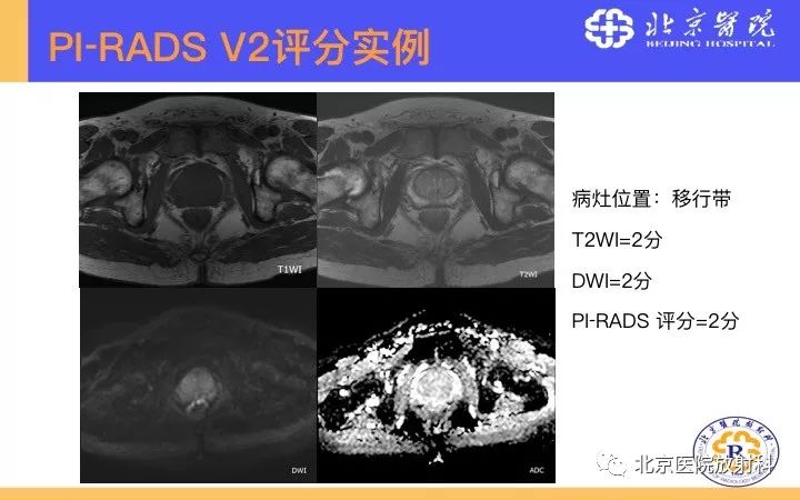 【PPT】男性盆腔常见疾病MR诊断