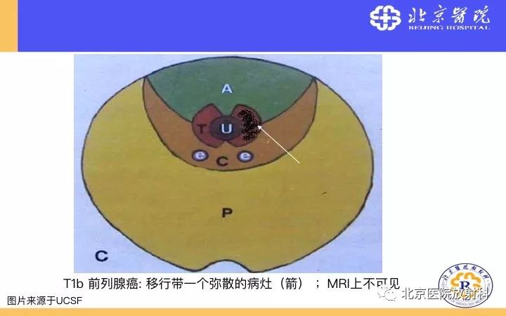 【PPT】男性盆腔常见疾病MR诊断
