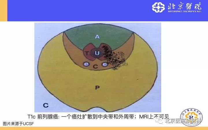【PPT】男性盆腔常见疾病MR诊断