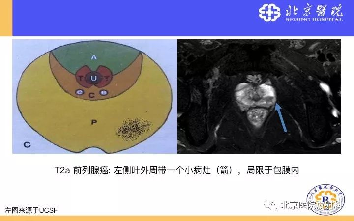 【PPT】男性盆腔常见疾病MR诊断