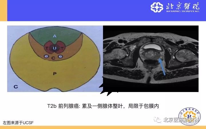 【PPT】男性盆腔常见疾病MR诊断
