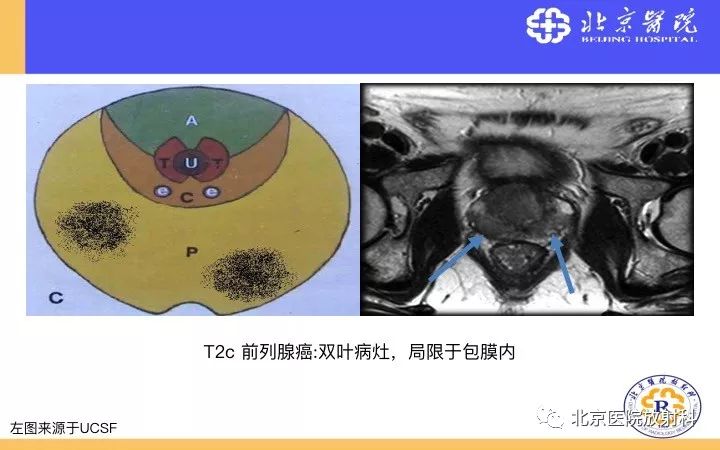 【PPT】男性盆腔常见疾病MR诊断