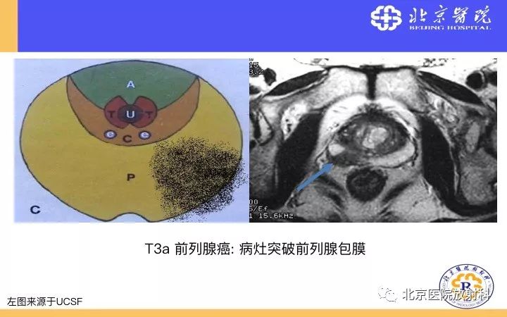 【PPT】男性盆腔常见疾病MR诊断