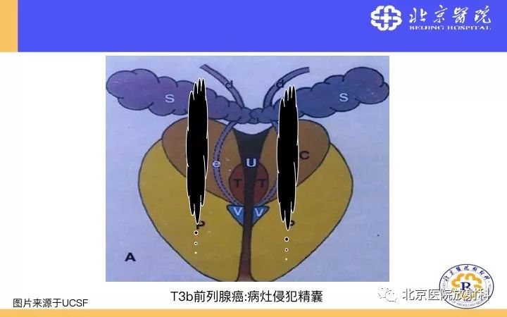【PPT】男性盆腔常见疾病MR诊断
