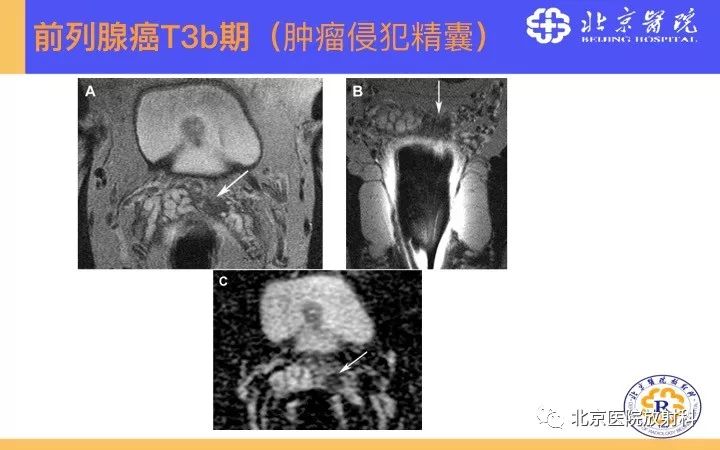 【PPT】男性盆腔常见疾病MR诊断
