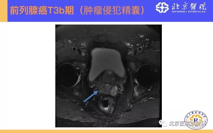 【PPT】男性盆腔常见疾病MR诊断