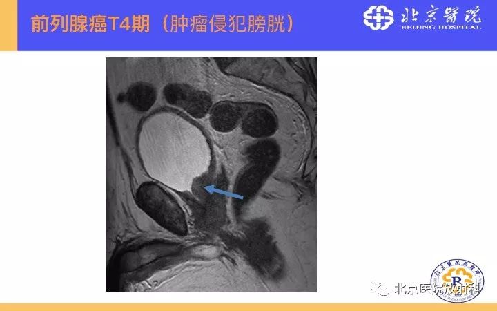 【PPT】男性盆腔常见疾病MR诊断