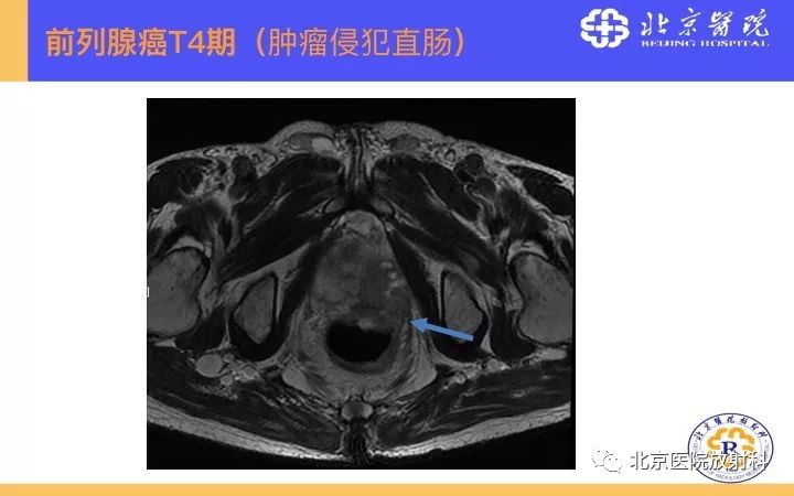 【PPT】男性盆腔常见疾病MR诊断