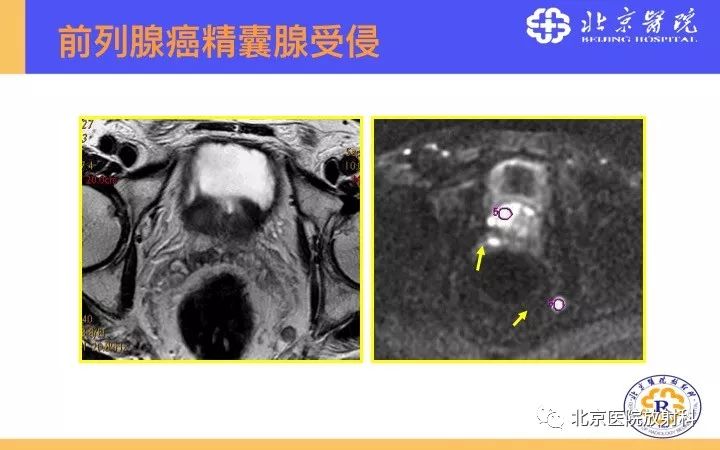 【PPT】男性盆腔常见疾病MR诊断