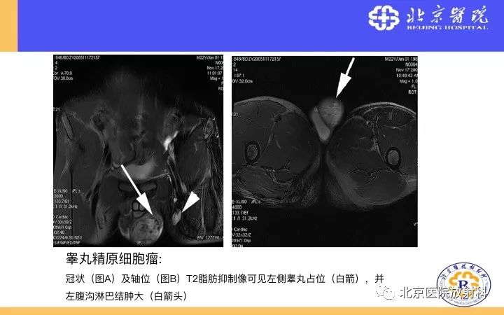 【PPT】男性盆腔常见疾病MR诊断