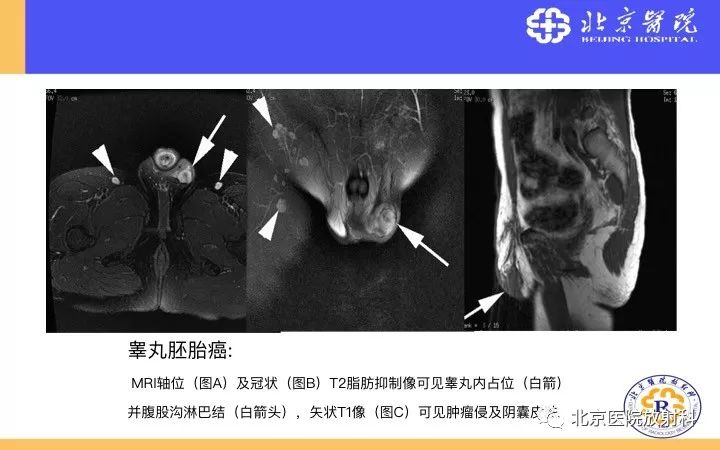 【PPT】男性盆腔常见疾病MR诊断