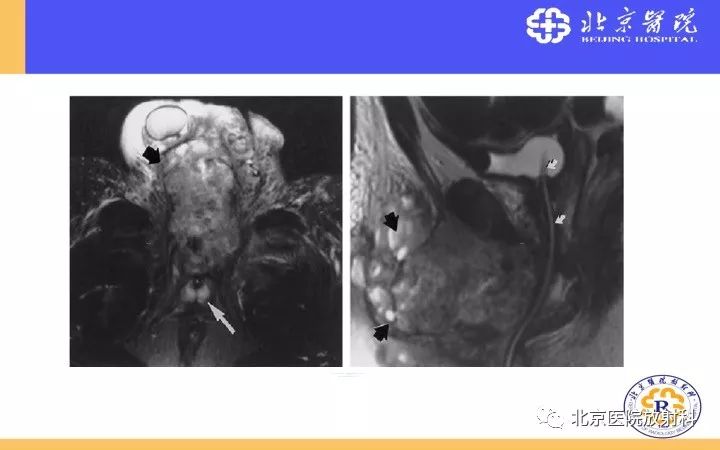 【PPT】男性盆腔常见疾病MR诊断
