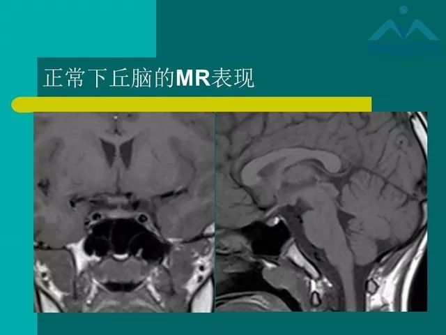【PPT】儿童Rathke裂囊肿的诊断要点及临床特征