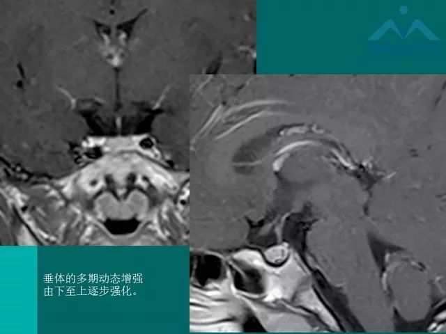【PPT】儿童Rathke裂囊肿的诊断要点及临床特征
