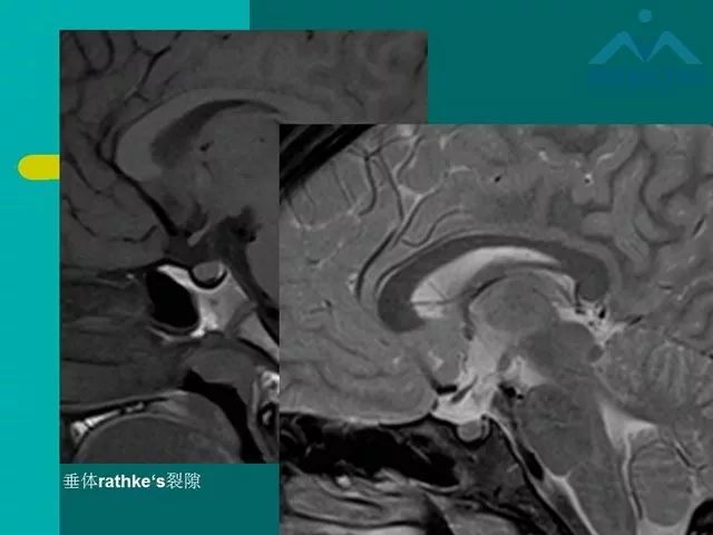 【PPT】儿童Rathke裂囊肿的诊断要点及临床特征