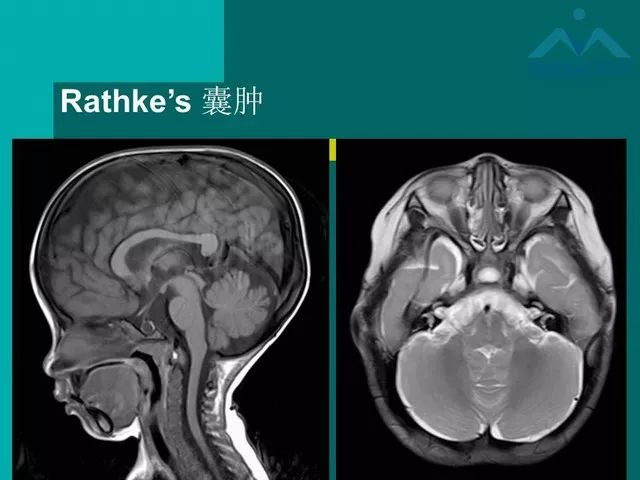 【PPT】儿童Rathke裂囊肿的诊断要点及临床特征