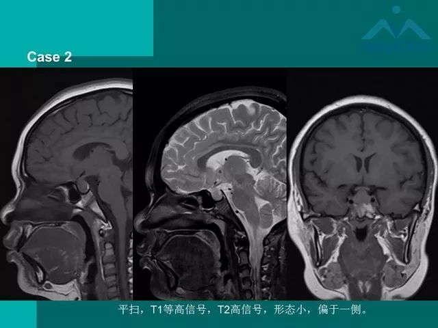 【PPT】儿童Rathke裂囊肿的诊断要点及临床特征