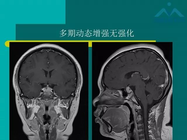 【PPT】儿童Rathke裂囊肿的诊断要点及临床特征