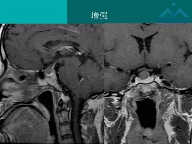 【PPT】儿童Rathke裂囊肿的诊断要点及临床特征