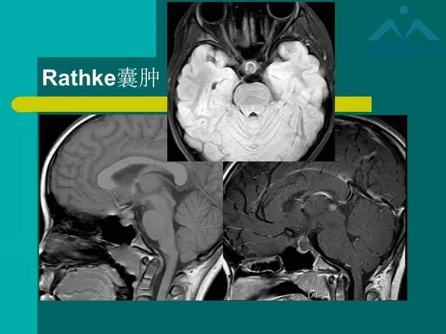 【PPT】儿童Rathke裂囊肿的诊断要点及临床特征