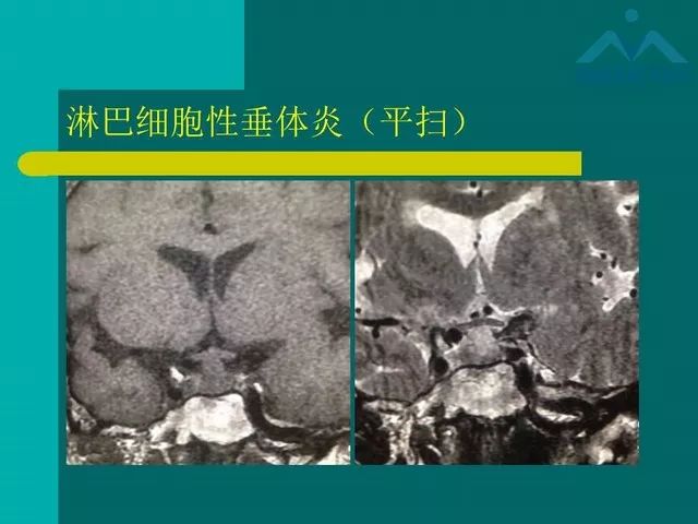 【PPT】儿童Rathke裂囊肿的诊断要点及临床特征