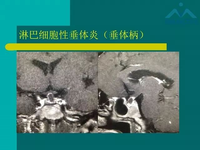 【PPT】儿童Rathke裂囊肿的诊断要点及临床特征