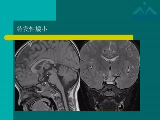 【PPT】儿童Rathke裂囊肿的诊断要点及临床特征