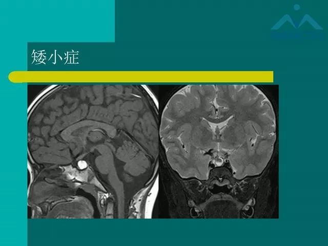 【PPT】儿童Rathke裂囊肿的诊断要点及临床特征