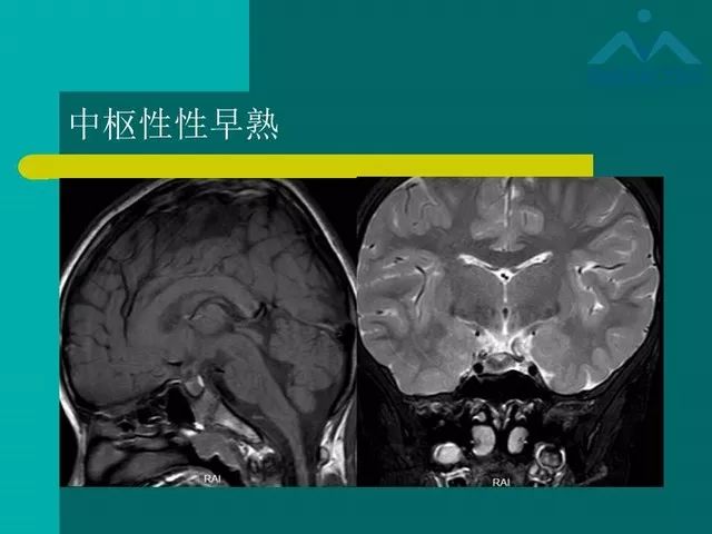 【PPT】儿童Rathke裂囊肿的诊断要点及临床特征