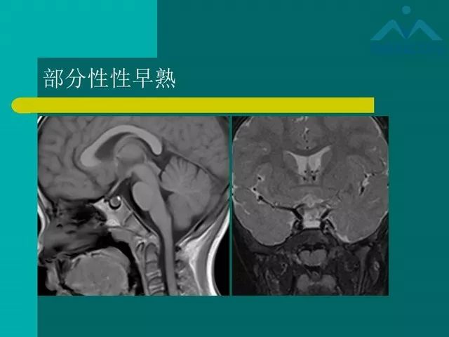 【PPT】儿童Rathke裂囊肿的诊断要点及临床特征