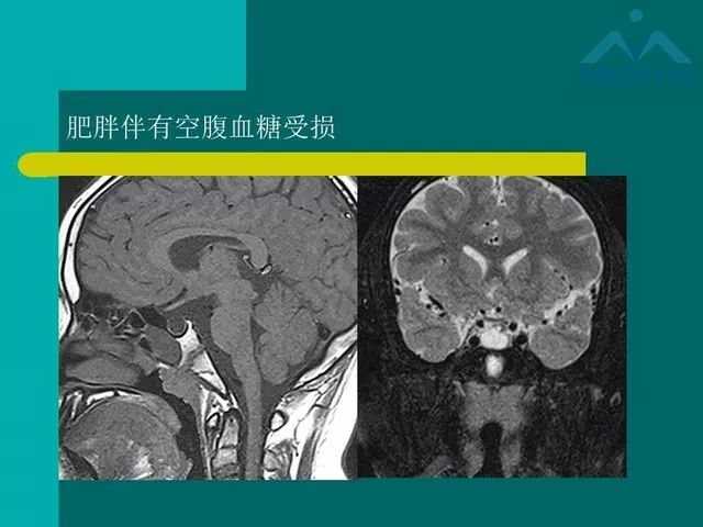 【PPT】儿童Rathke裂囊肿的诊断要点及临床特征