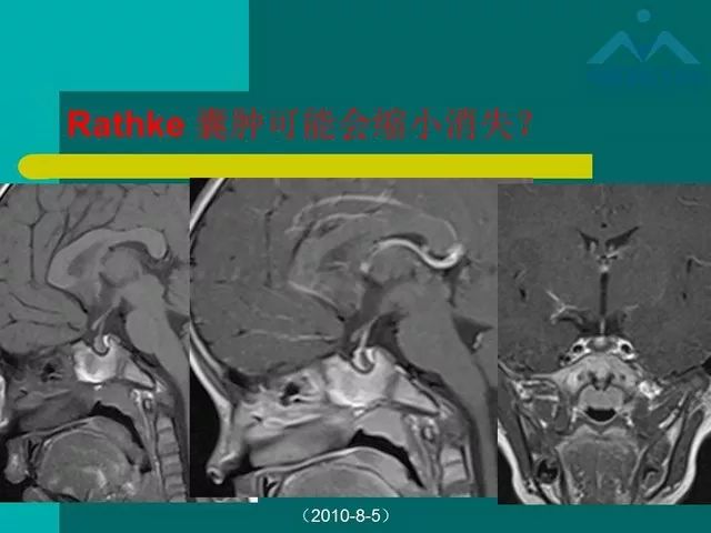 【PPT】儿童Rathke裂囊肿的诊断要点及临床特征