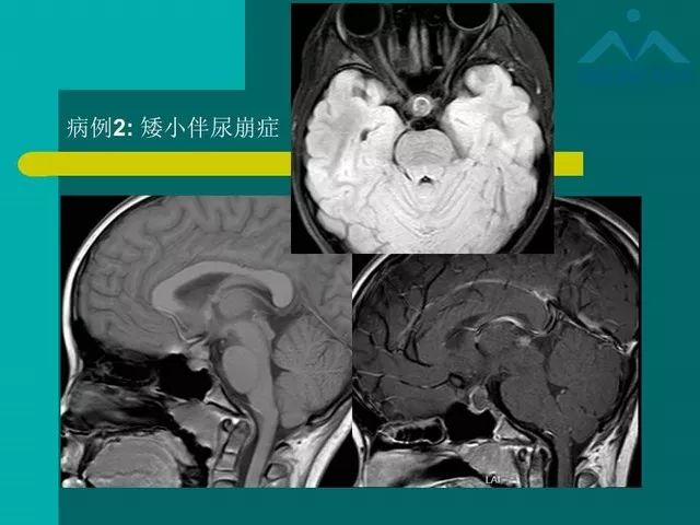 【PPT】儿童Rathke裂囊肿的诊断要点及临床特征