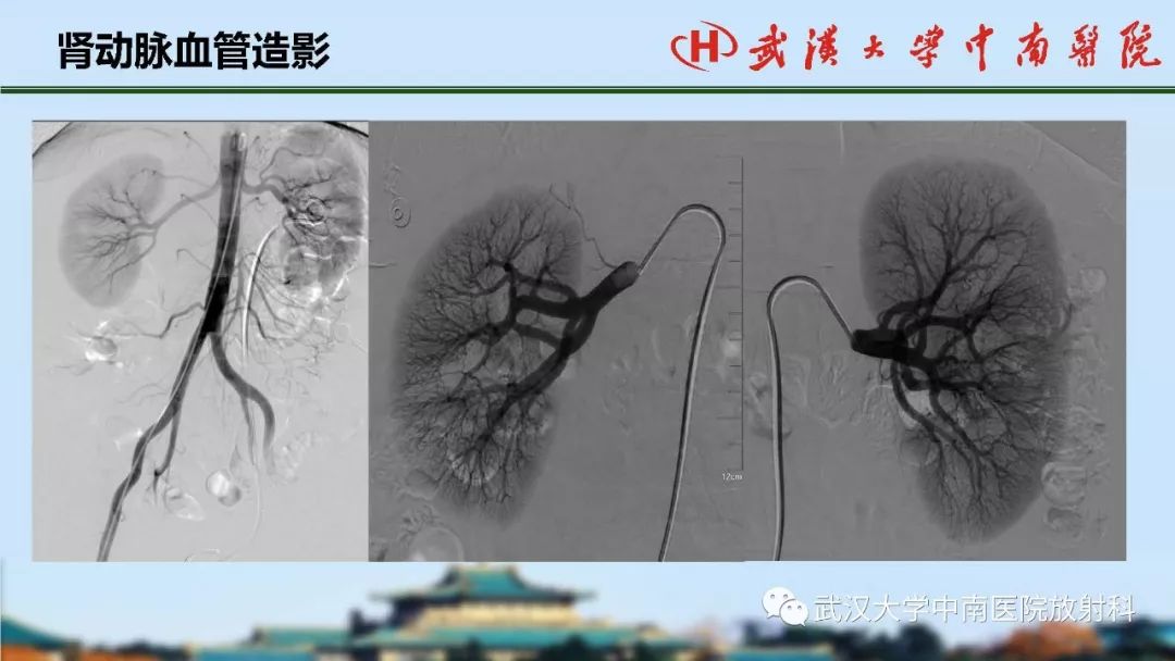 【PPT】肾脏解剖与实性肿瘤