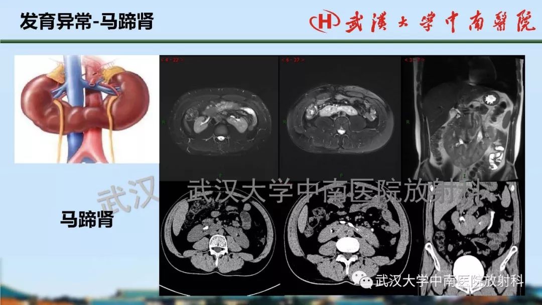 【PPT】肾脏解剖与实性肿瘤