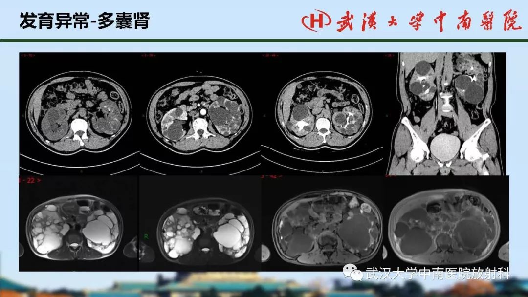 【PPT】肾脏解剖与实性肿瘤