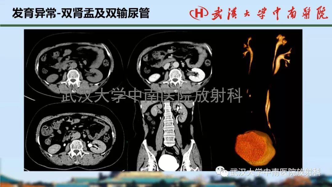 【PPT】肾脏解剖与实性肿瘤
