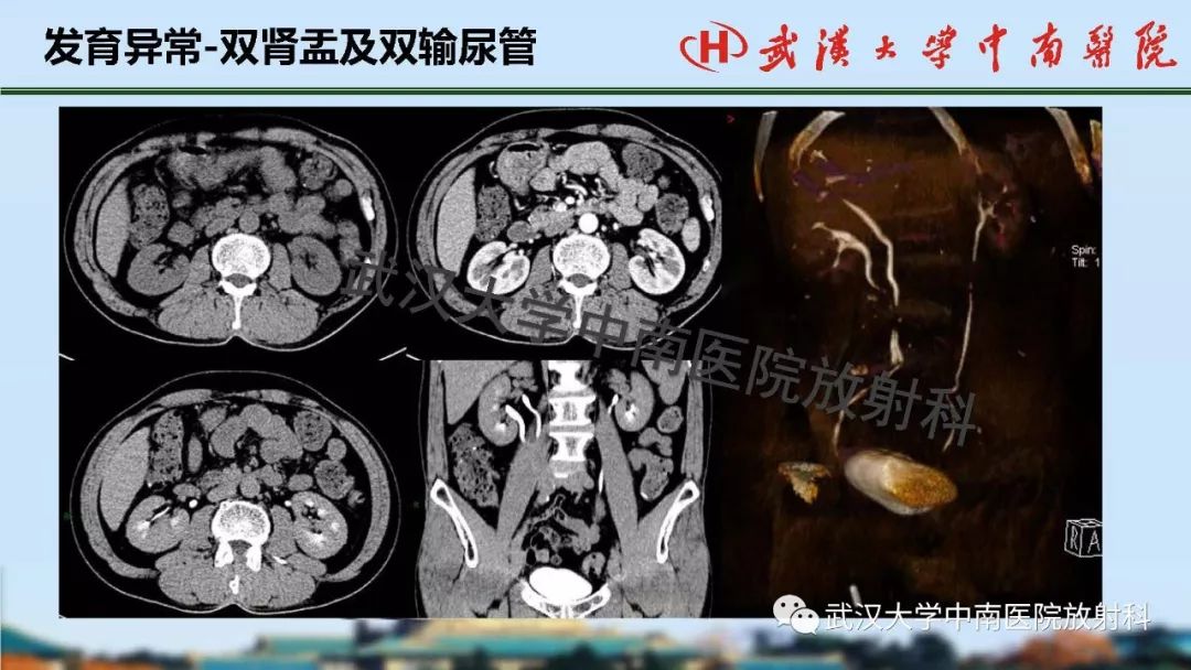 【PPT】肾脏解剖与实性肿瘤
