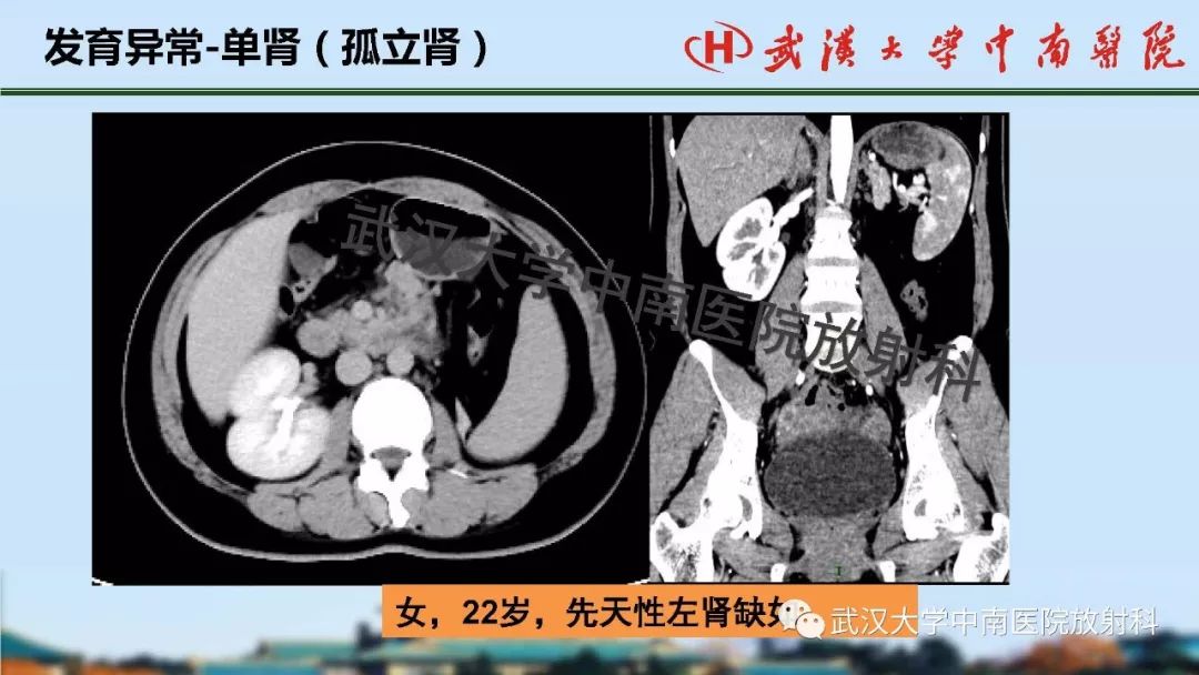 【PPT】肾脏解剖与实性肿瘤
