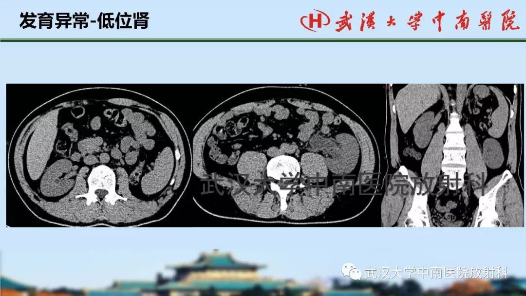 【PPT】肾脏解剖与实性肿瘤