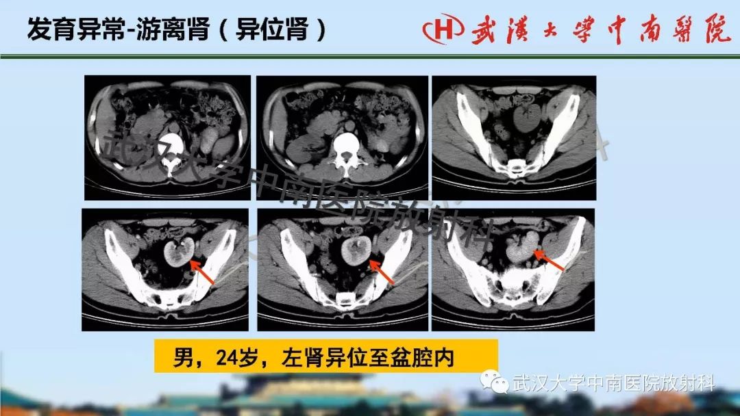 【PPT】肾脏解剖与实性肿瘤