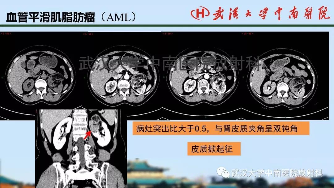 【PPT】肾脏解剖与实性肿瘤