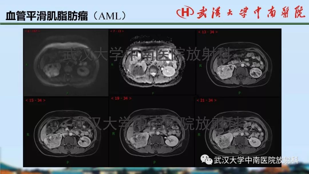 【PPT】肾脏解剖与实性肿瘤
