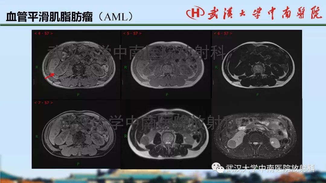 【PPT】肾脏解剖与实性肿瘤