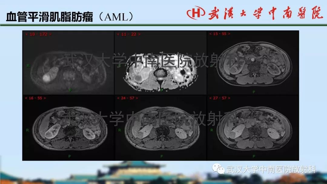 【PPT】肾脏解剖与实性肿瘤