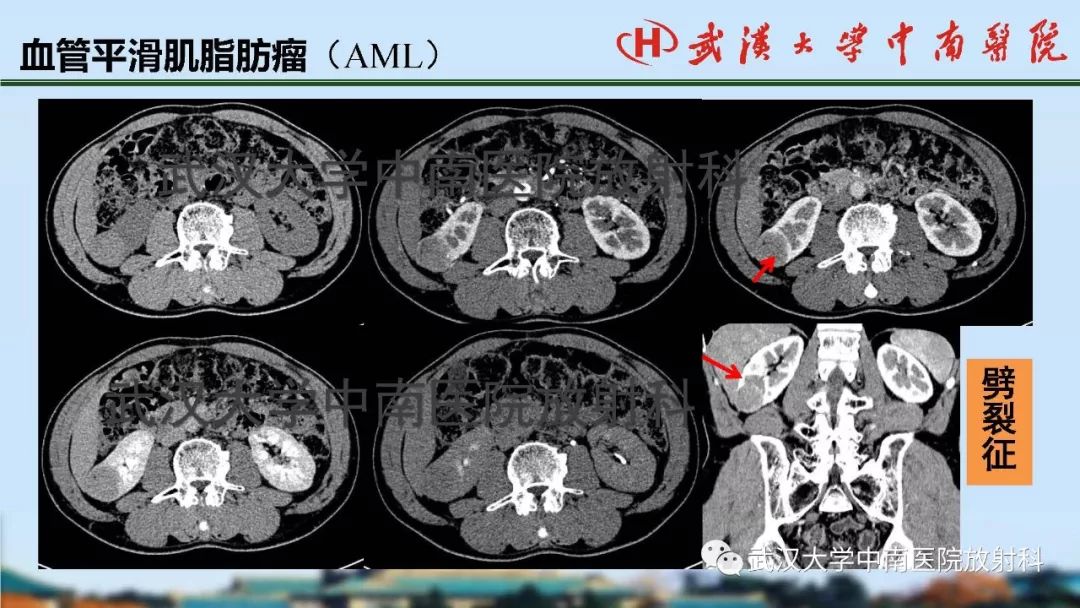 【PPT】肾脏解剖与实性肿瘤