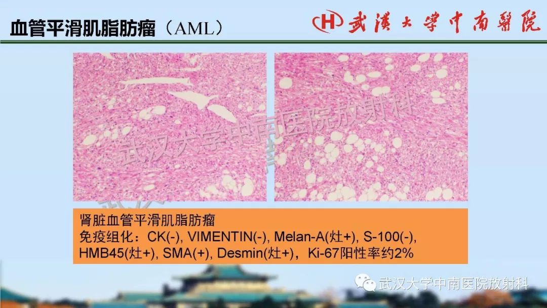 【PPT】肾脏解剖与实性肿瘤